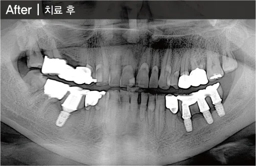 틀니를 임플란트로 교체한 증례(하악-04개(하악덴쳐를 임플란트로) 치료 후